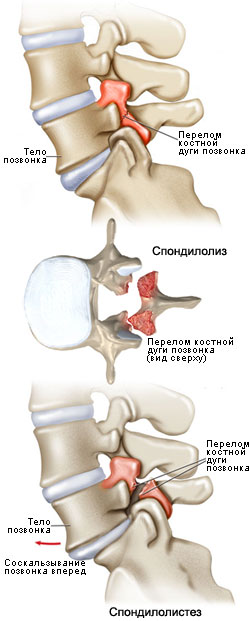 Спондилолиз с последующим спондилолистезом. 